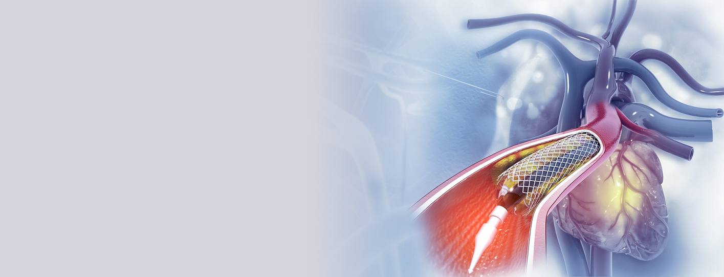 Complex Coronary Angioplasty: A Lifesaving Option For Blocked Arteries